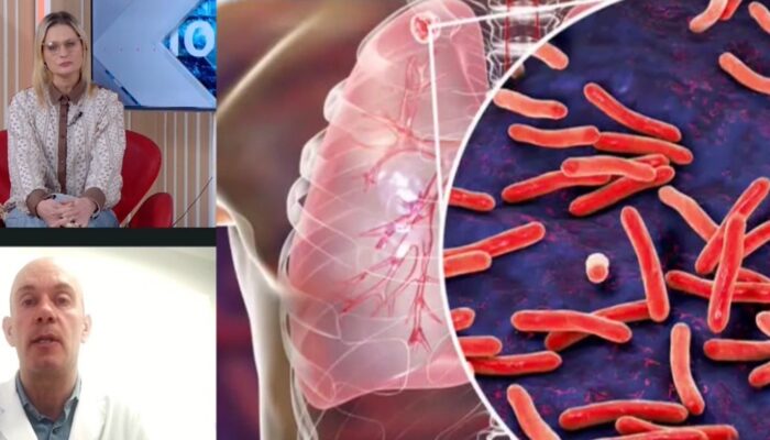Preocupa el aumento de casos de tuberculosis en la Argentina 1 ok